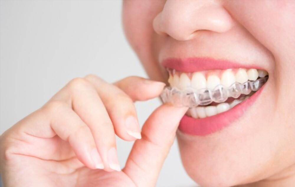 Dental Braces: